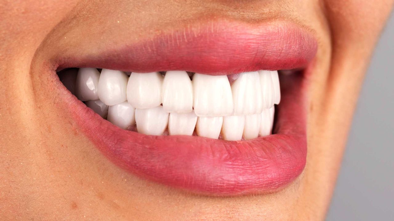 Dental Cleaning & Veneers in St. Marys, GA Richard L Spencer DDS